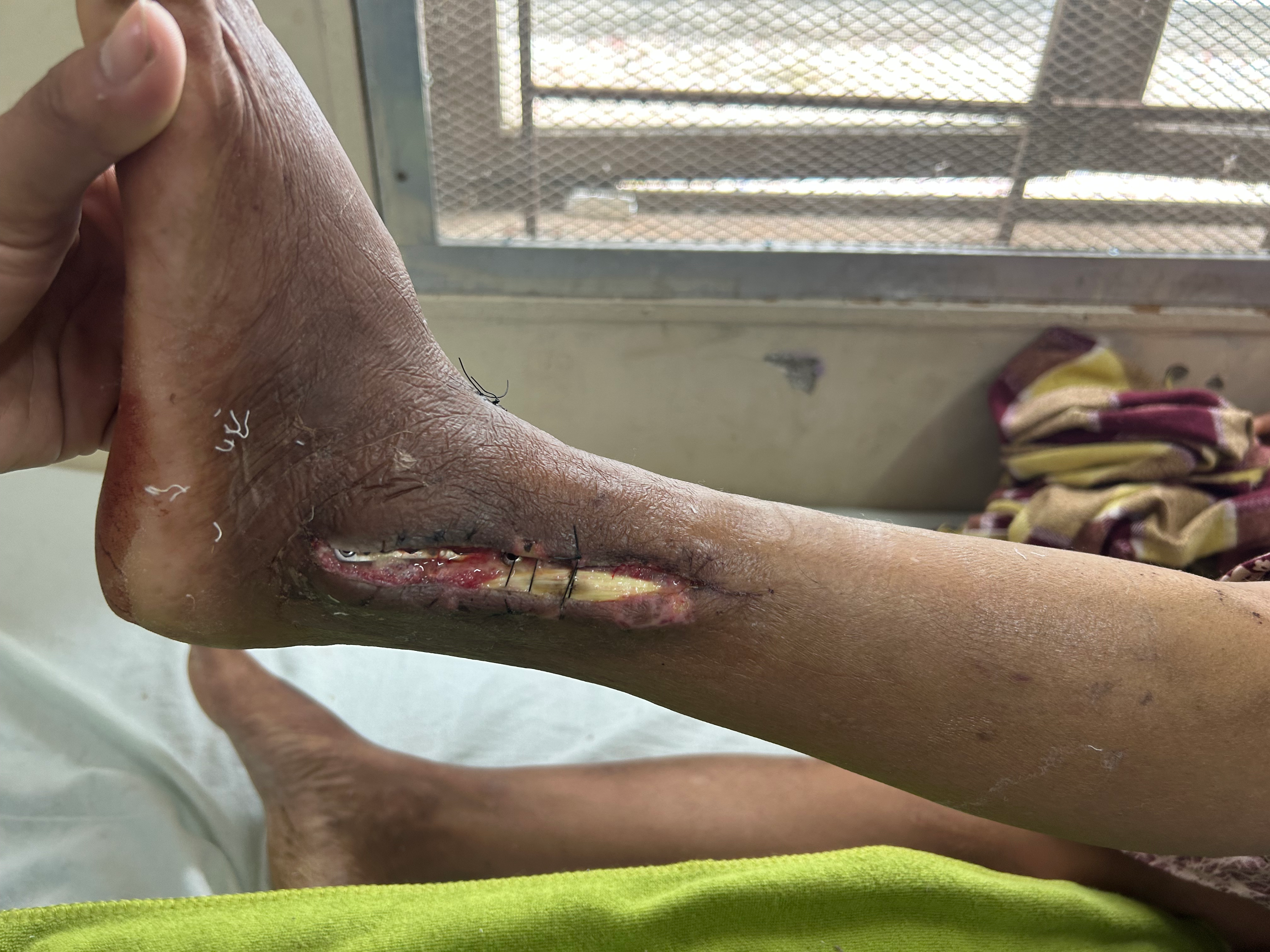 Lower Limb Trauma Defect Reconstruction